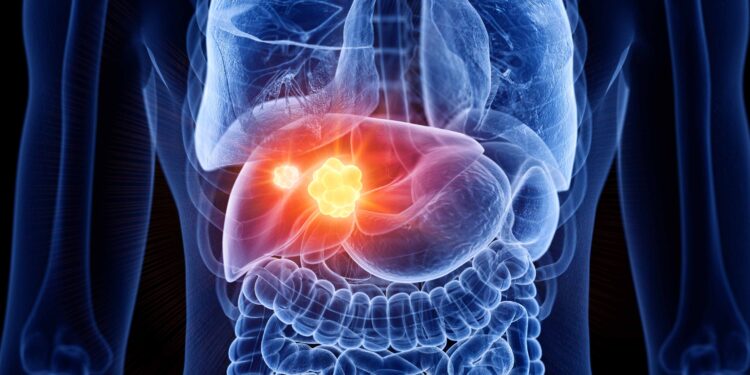 সাৱধান! ডায়েবেটিছ আৰু উচ্চ কলেষ্টেৰলত ভোগা ৰোগীৰ হ’ব পাৰে লিভাৰ কেন্সাৰ…