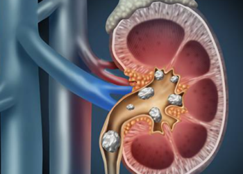 কিডনী ষ্ট’নত ভুগিলে কি কি খাব আৰু কি কি নাখাব, জানি লওক