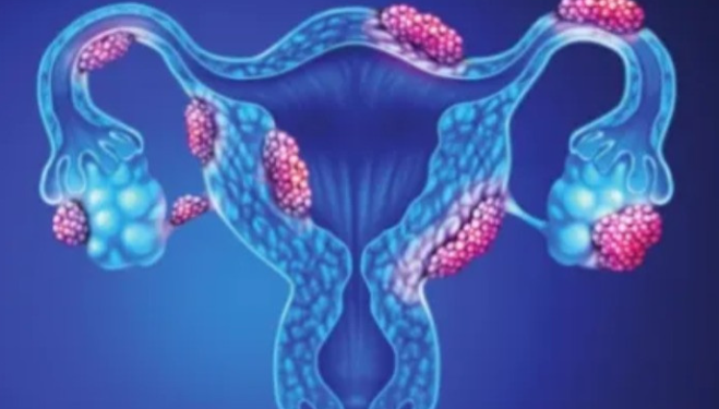 Uterus Infection কি? জানক ইয়াৰ লক্ষণসমূহ