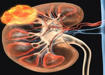 দেশত প্ৰথমবাৰৰ বাবে কিডনী বাইলেটেৰেল উইলমছ টিউমাৰৰ অস্ত্ৰোপচাৰ, কি এই ৰোগ?