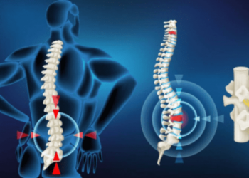 স্লিপ ডিস্ক কি, কিয় হয়, ইয়াৰ লক্ষণসমূহ কি আৰু ইয়াক কেনেকৈ প্ৰতিৰোধ কৰিব পাৰি?